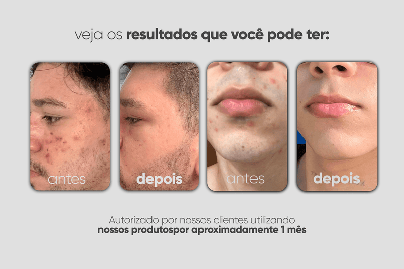 Dupla Antiacne: Limpa Antiacne e Gel Creme Antiacne
