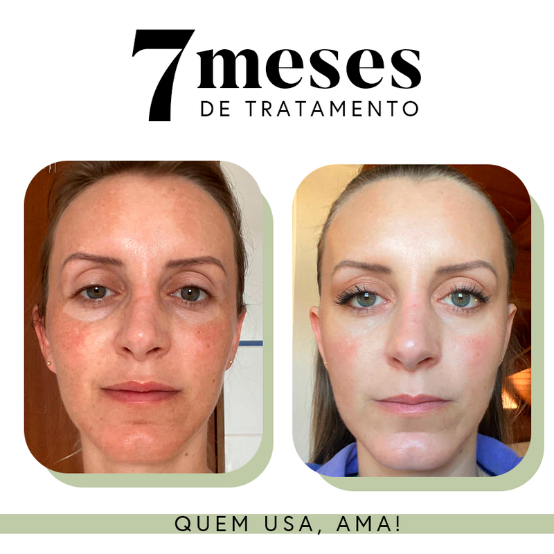 Ritual Essencial para Manchas e Melasma