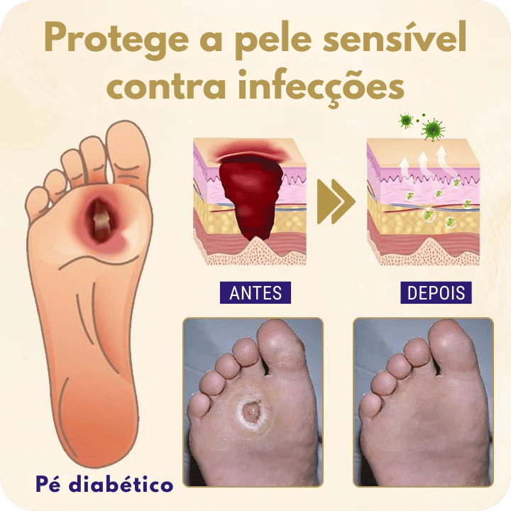 Spray Cicatrizante para Feridas, Úlceras e Pé Diabético